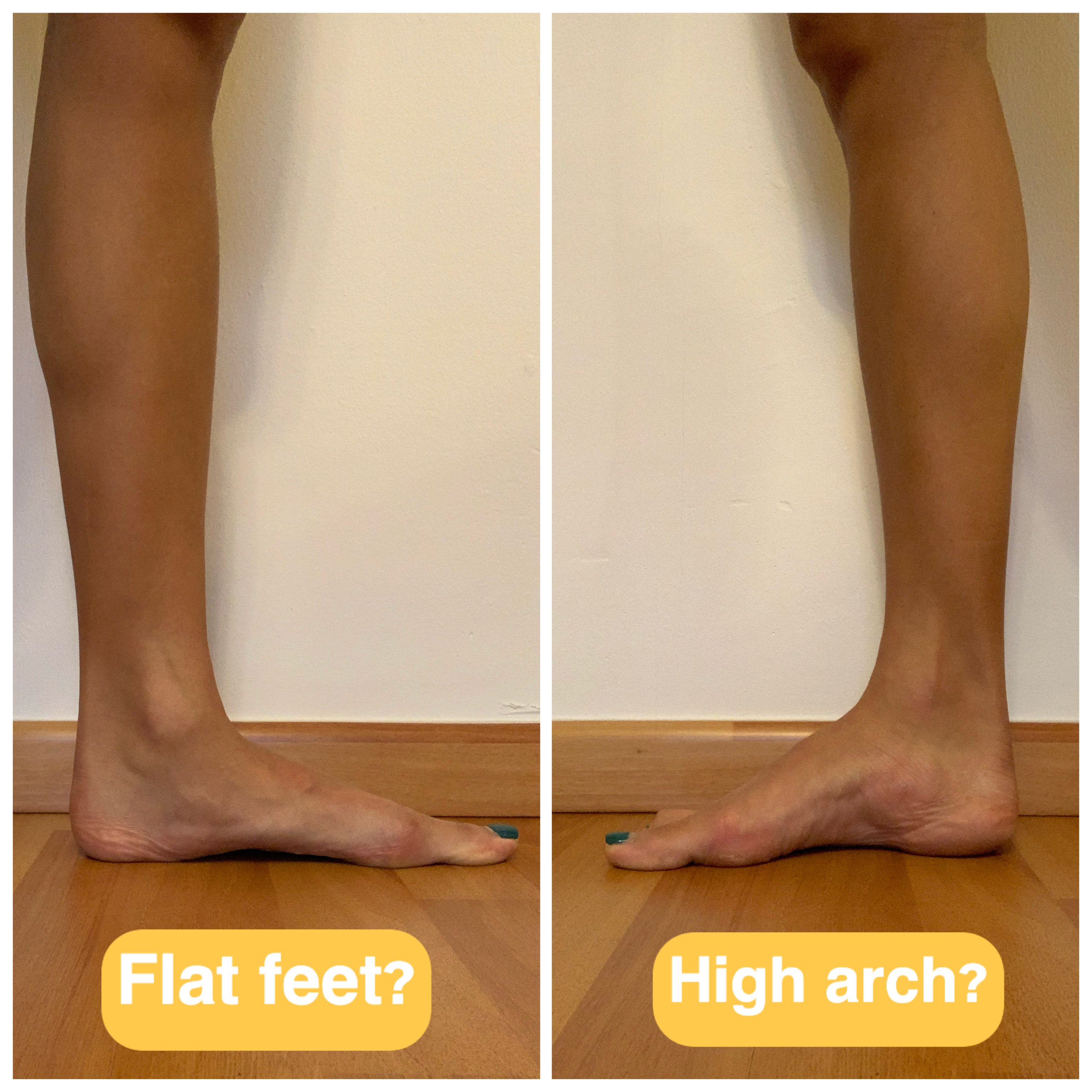 UFIT Physio - Flat feet vs high arch