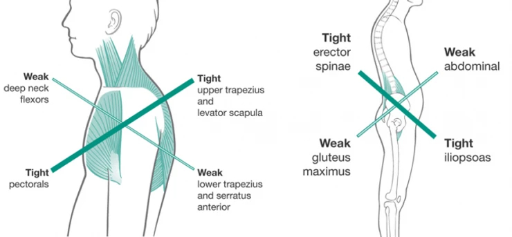 Golf blog - Cross syndrome