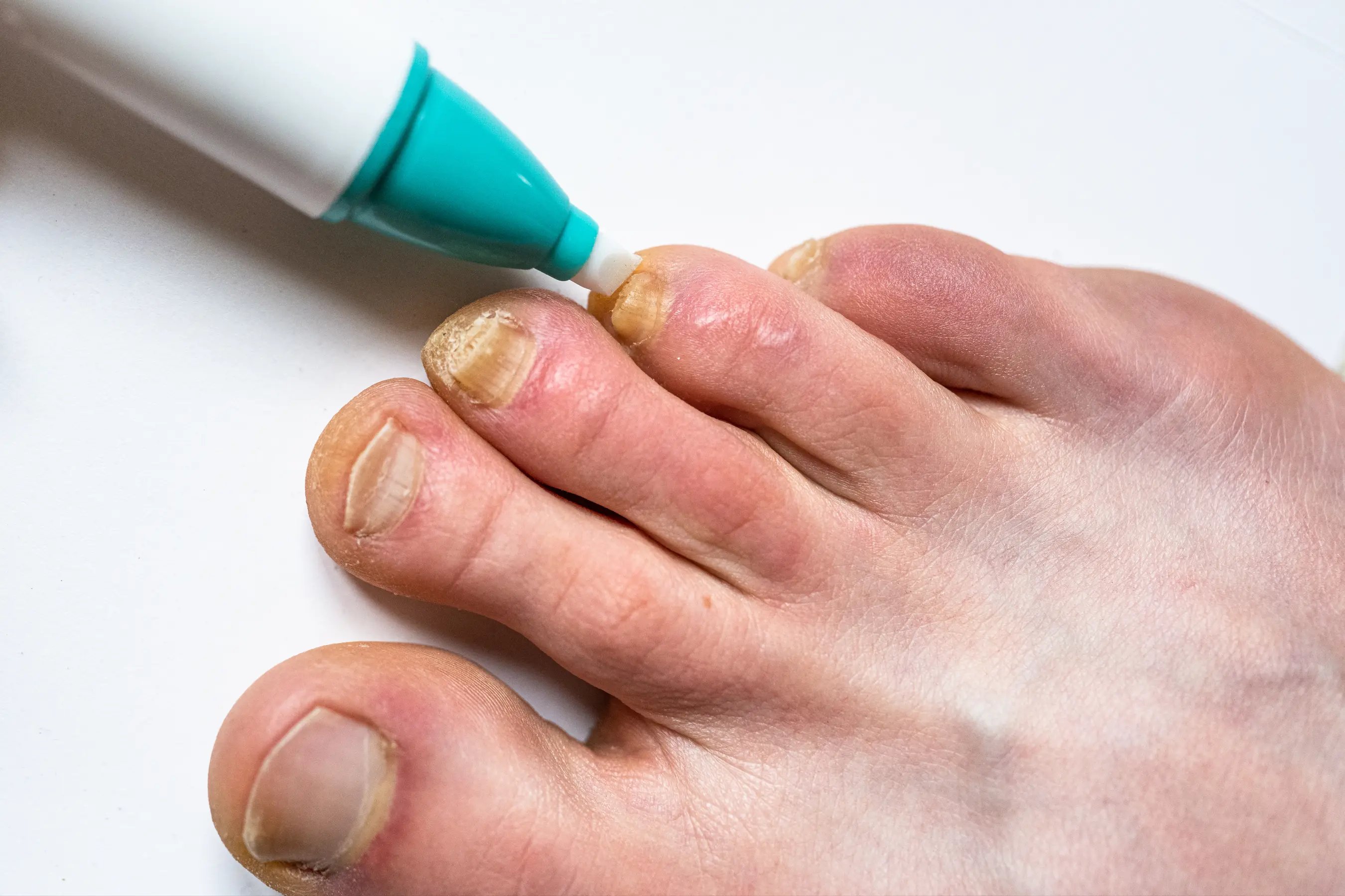 Toe Nail Fungus Infection