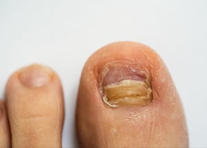is-your-yellow-brown-toenail-a-fungal-nail-infection