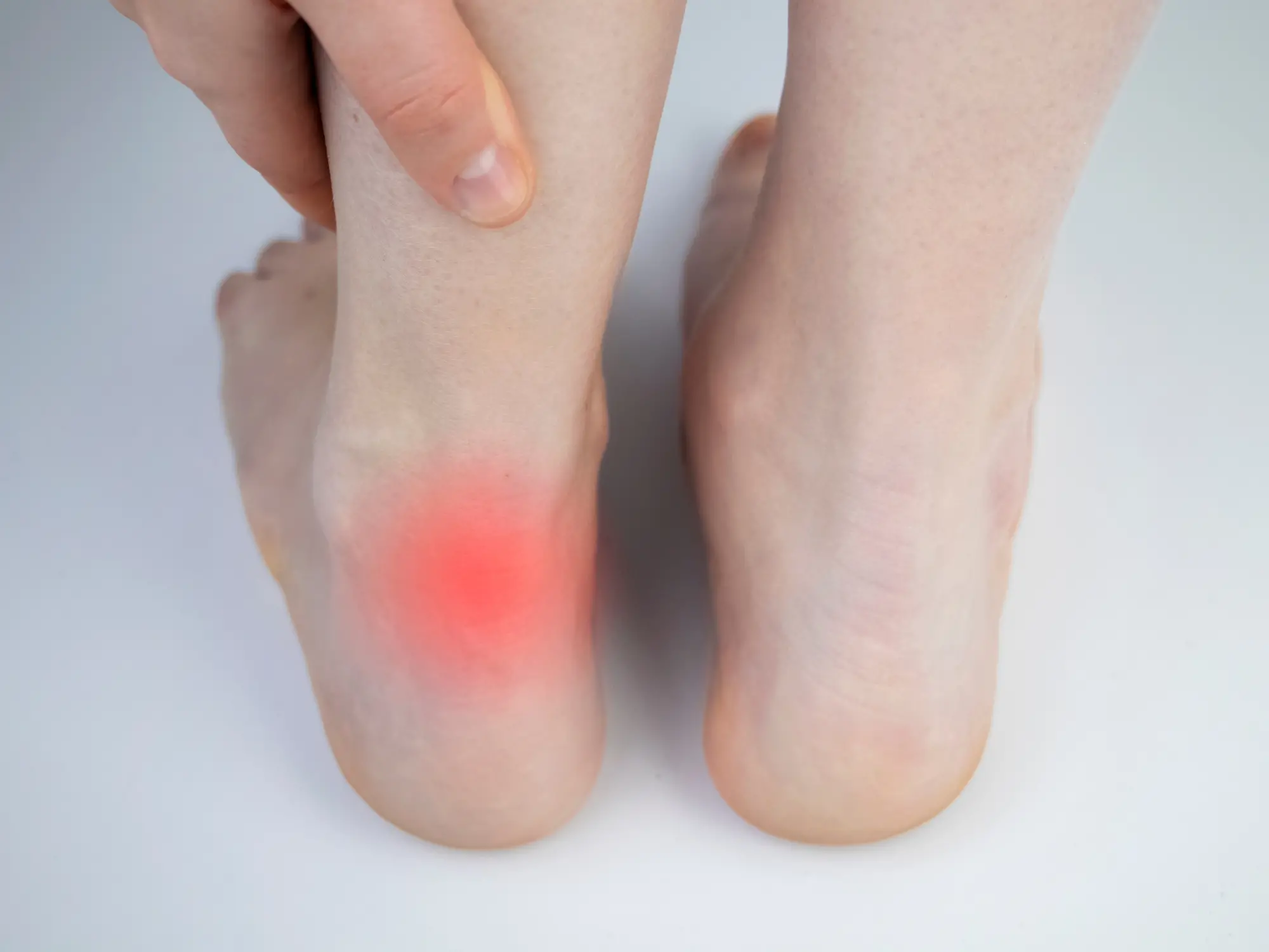 Achilles Tendonitis