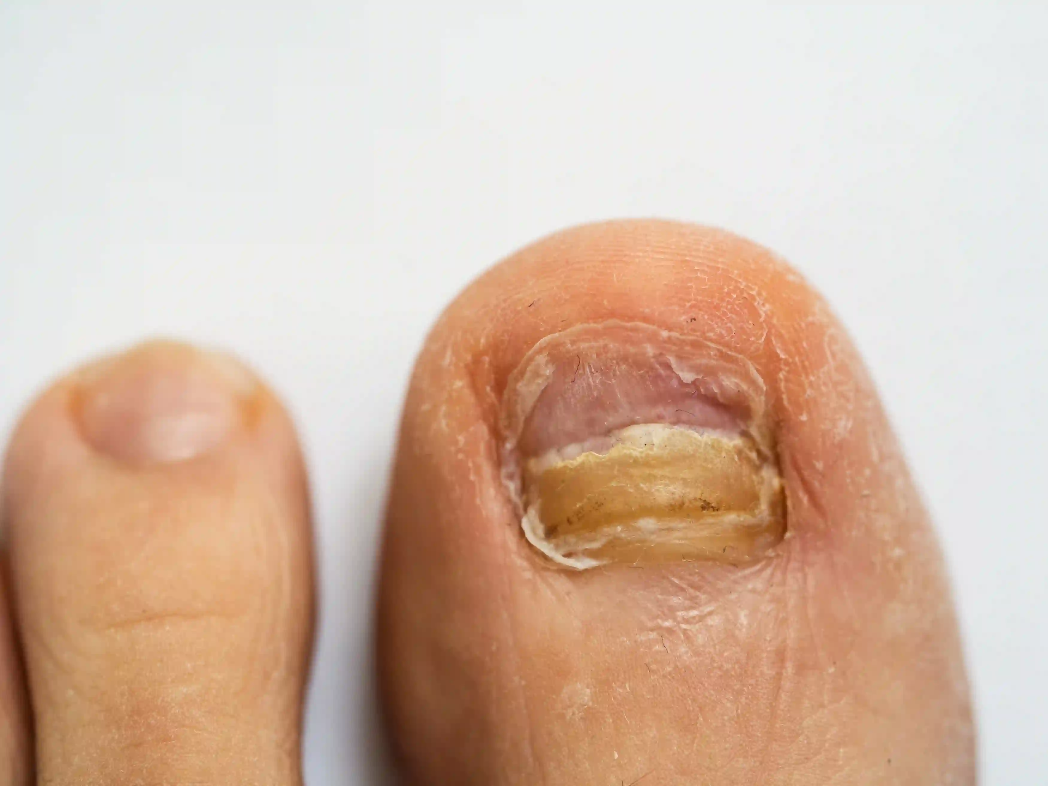 Fungal Nails