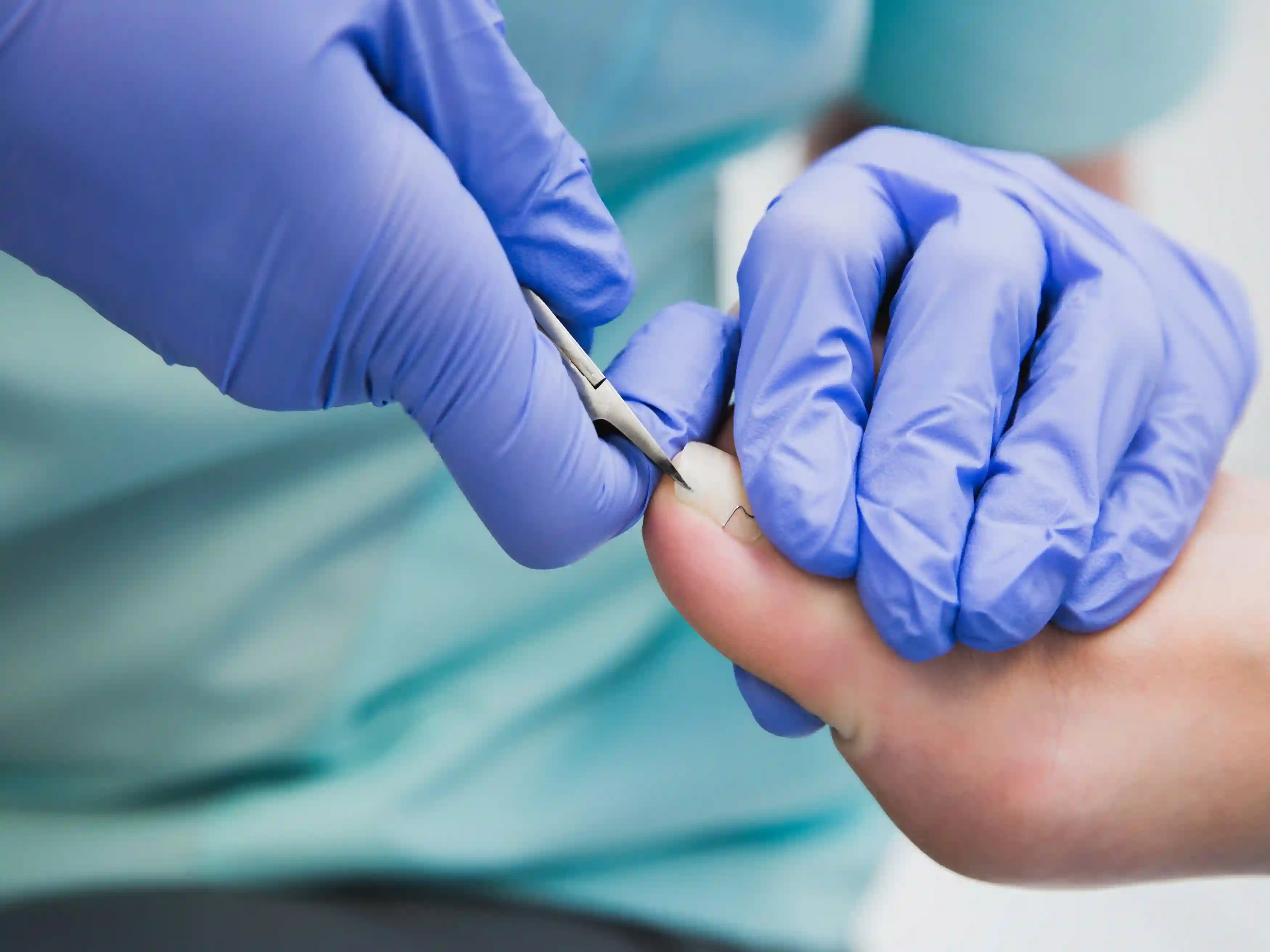 Ingrown Nails