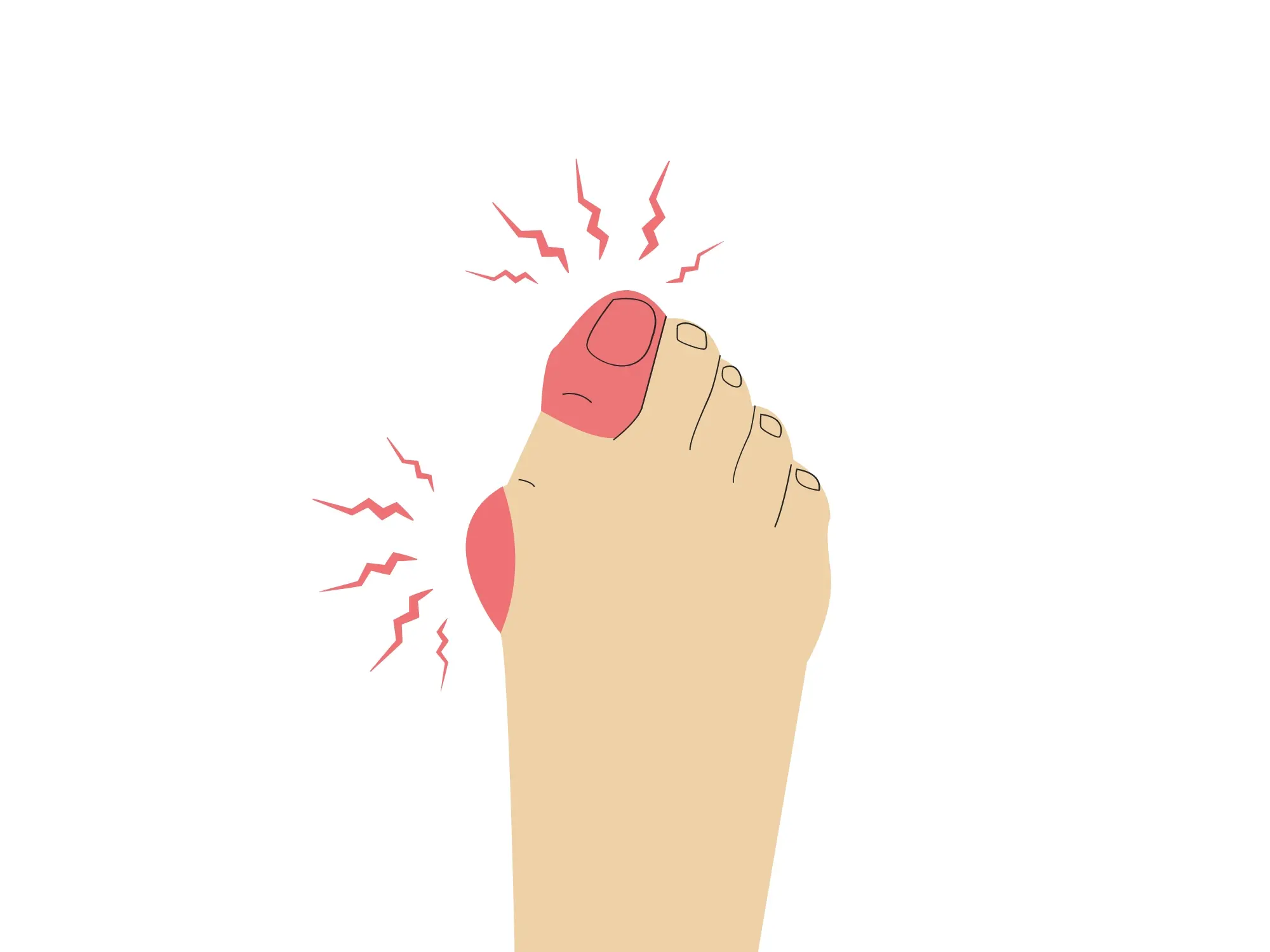 Juvenile Bunions