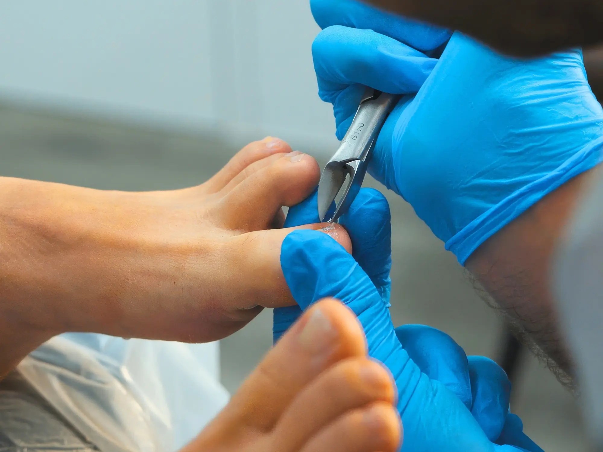 Step 3: Nail Drainage or Nail Removal