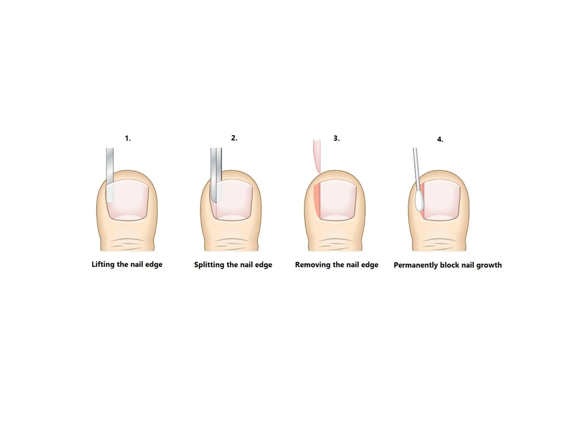 Partial nail avulsion image Partial nail avulsion image