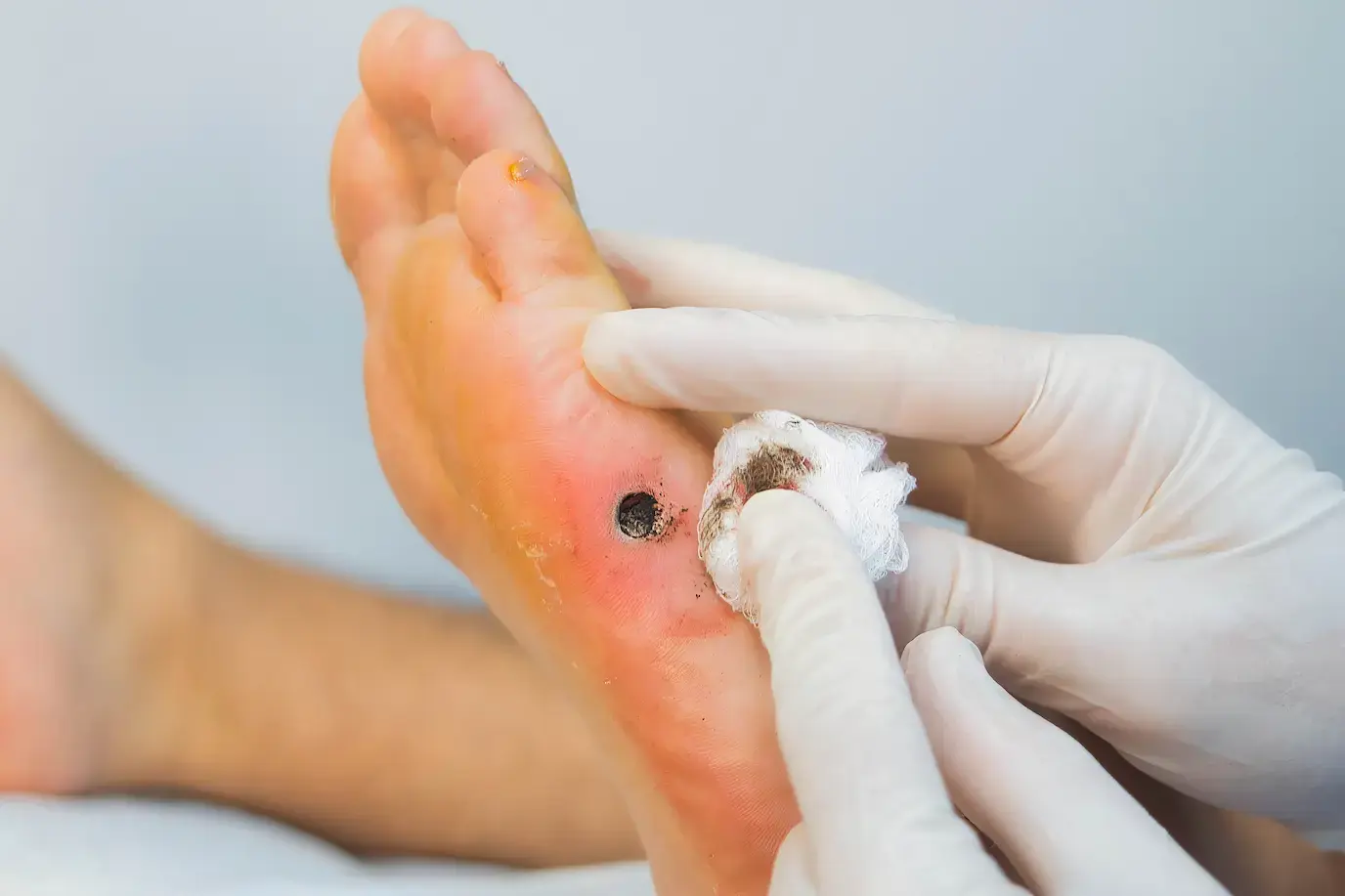 4. Excision Procedures