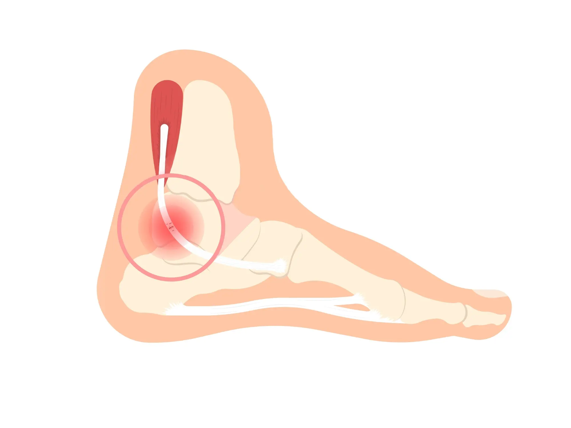 Posterior Tibial Tendon Dysfunction (PTTD)
