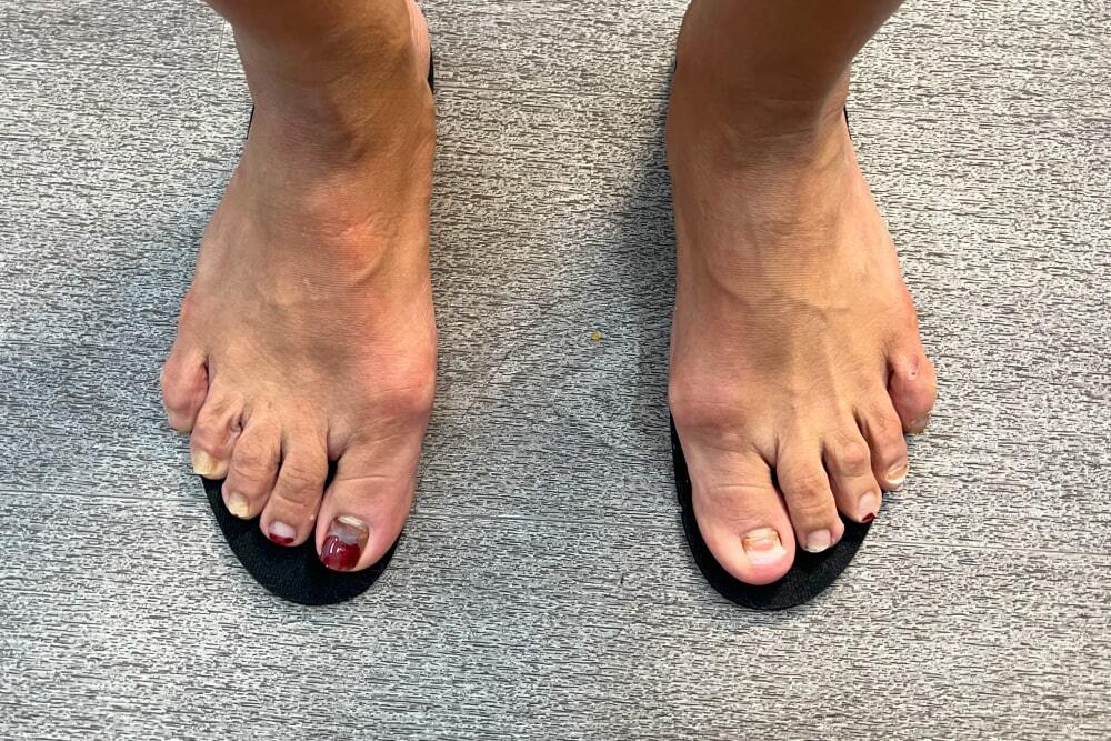 avoid-tight-or-narrow-shoes